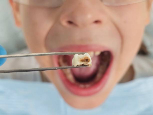 Best Emergency Treatment for Toothache in New London, TX